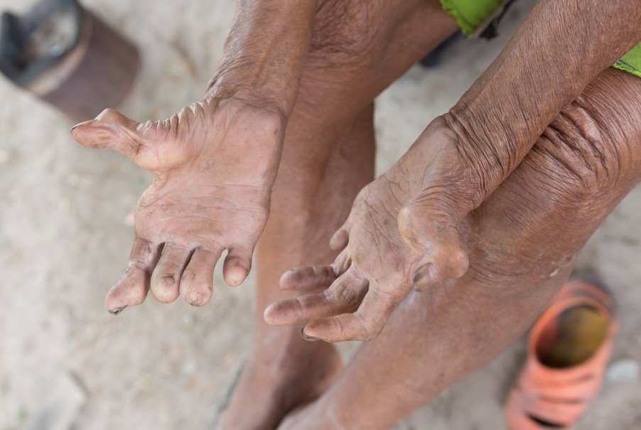 Terbanyak Ketiga Dunia, Penderita Kusta di Indonesia Capai 11.173 Orang