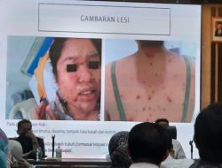 Dinkes Antisipasi Penyakit Monkeypox Masuk Batam
