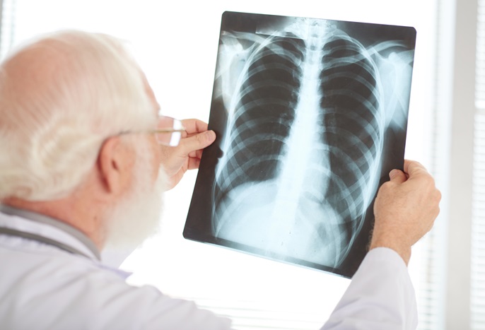 Ilustrasi - Pneumonia atau paru-paru basah, merupakan infeksi yang disebabkan oleh bakteri, virus, atau jamur.